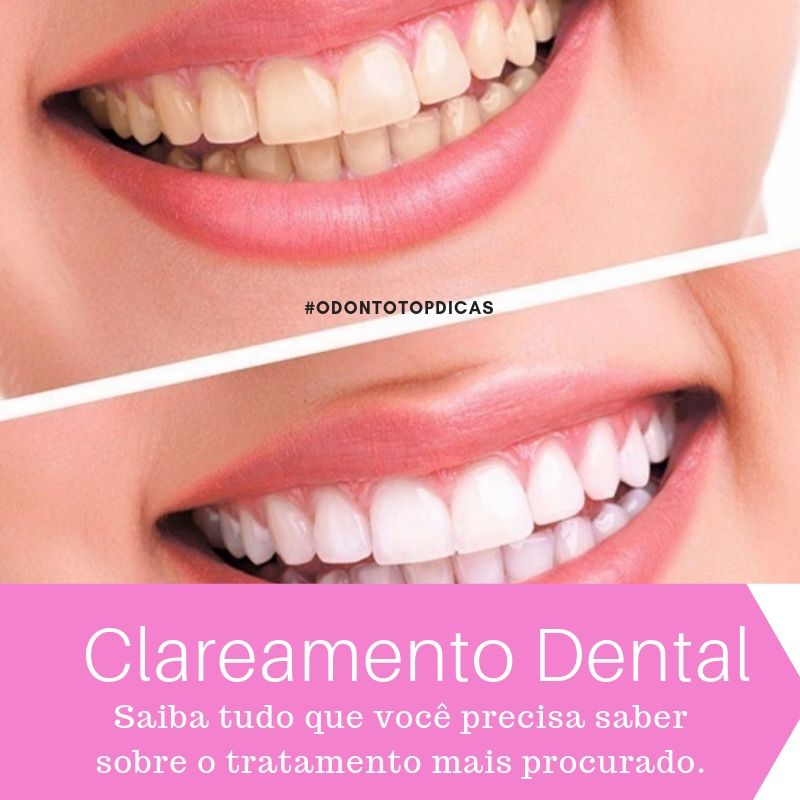 Read more about the article Clareamento Dental